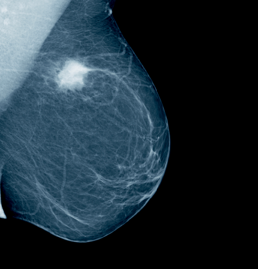 brustmammographie